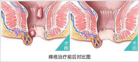 美國PPH微創(chuàng)治療技術(shù)圖片