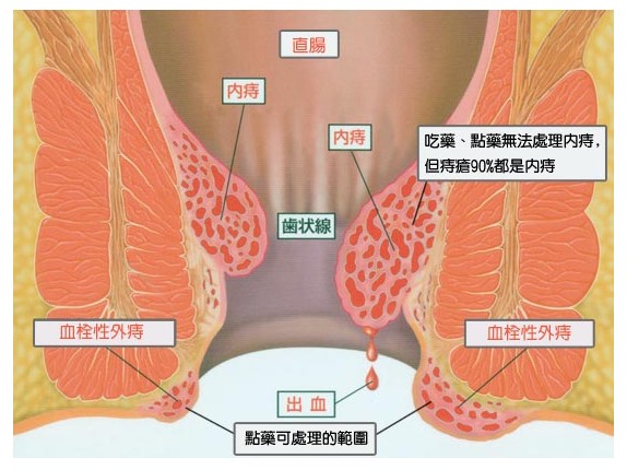 痔瘡